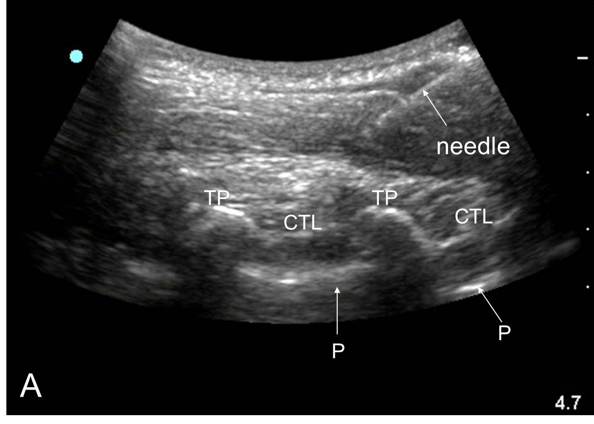 Ultrasound scan of the thoracic paravertebral space