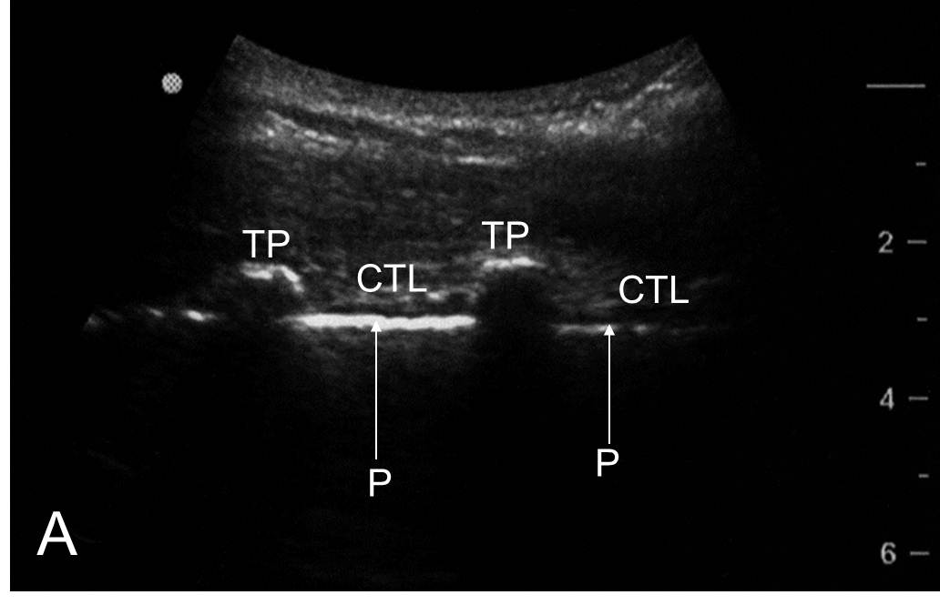 Ultrasound scan of the thoracic level 