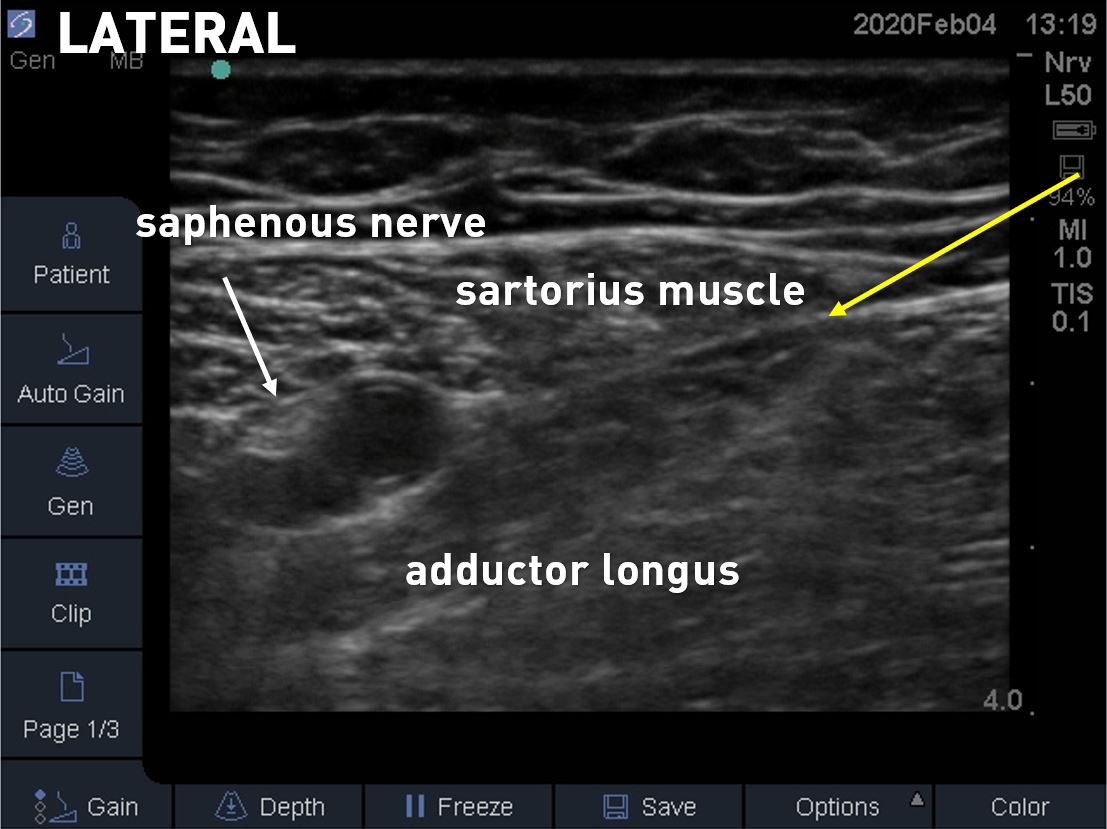 proximal adductor canal 