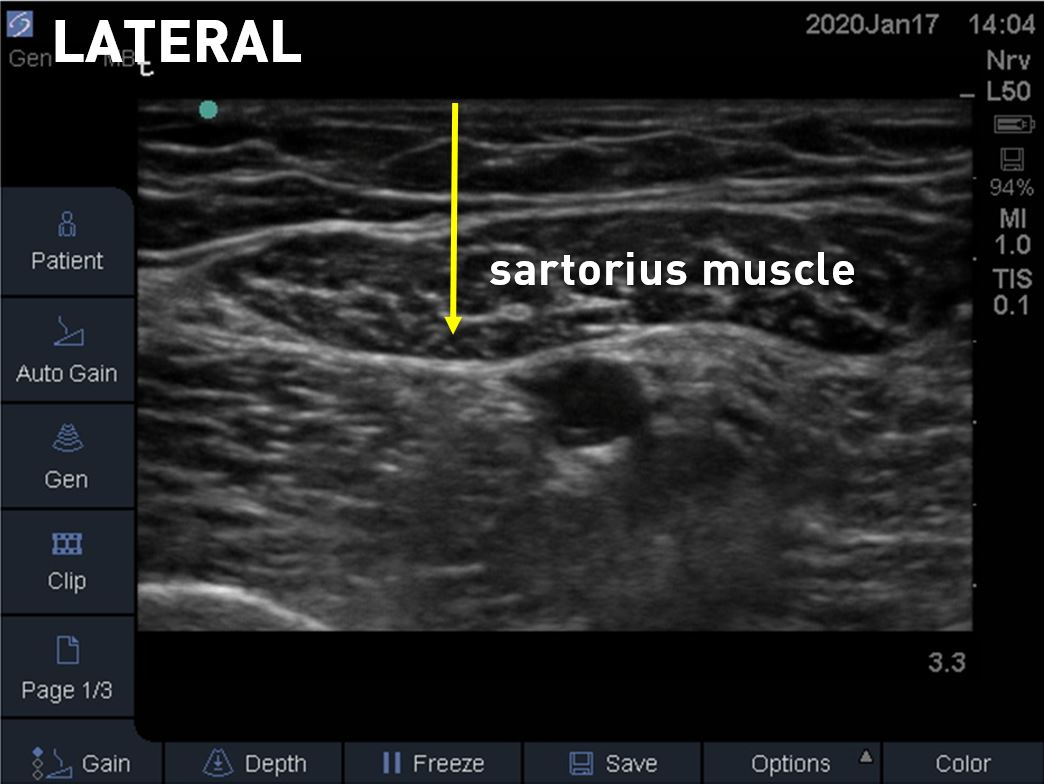 adductor canal with the yellow arrow demarcating the vastoadductor membrane
