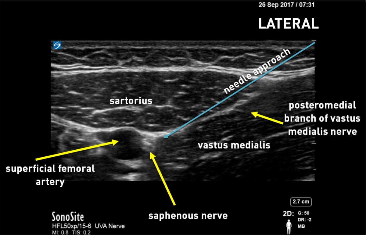 proximal adductor canal demonstrating the saphenous nerve