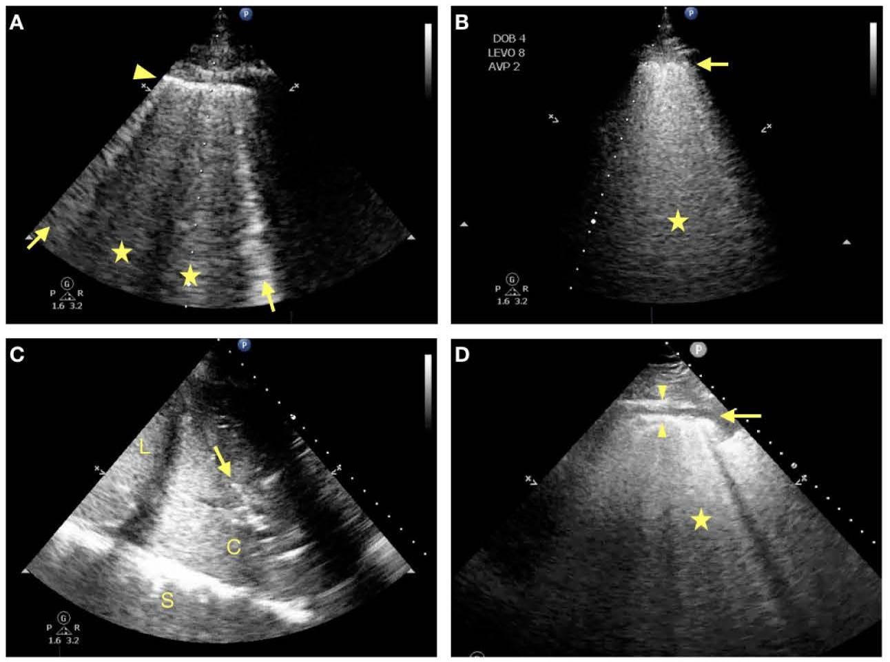 Lung ultrasound findings in COVID-19 patients