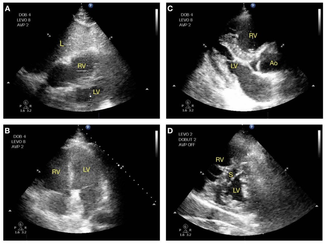  Cardiac ultrasound findings in COVID-19 patients