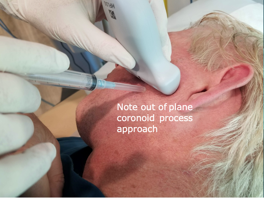  Injection approach: Coronoid process