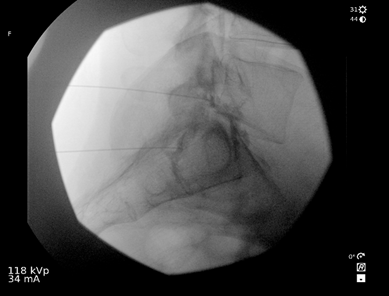 The final needle position in oblique view for right L5 and S1 transforaminal injection and the corresponding position of the C-arm.