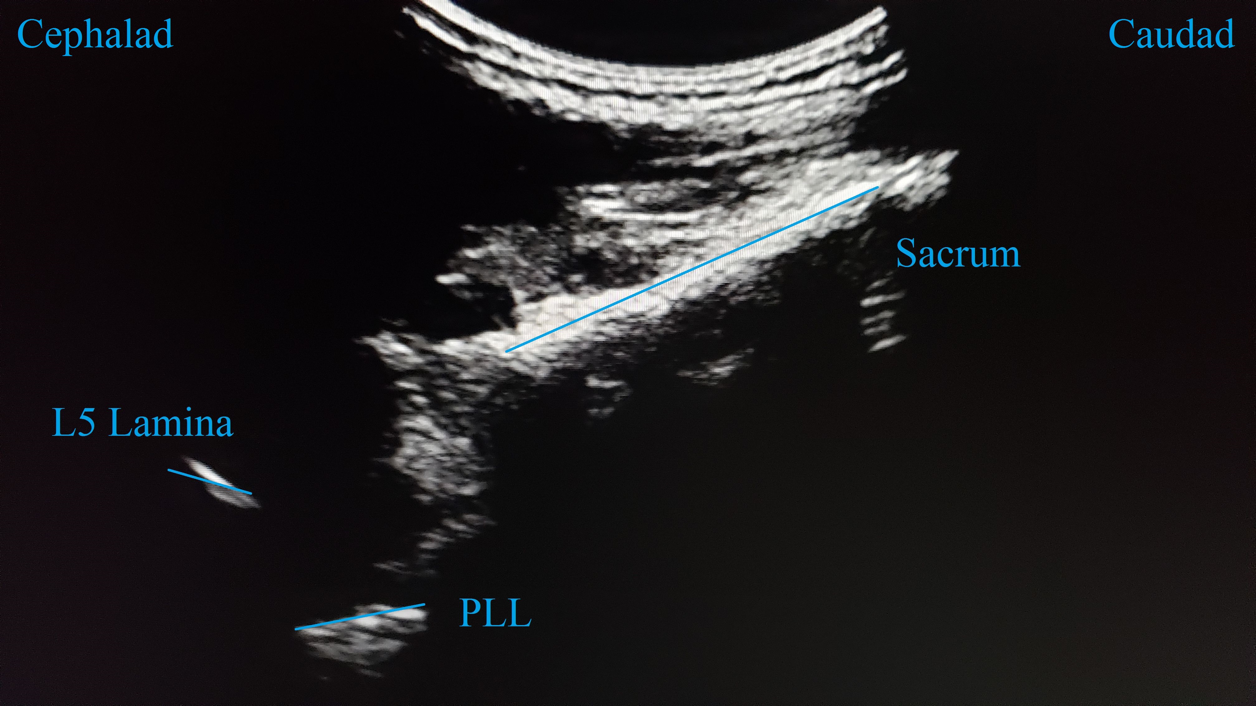 paramedian sagittal oblique view