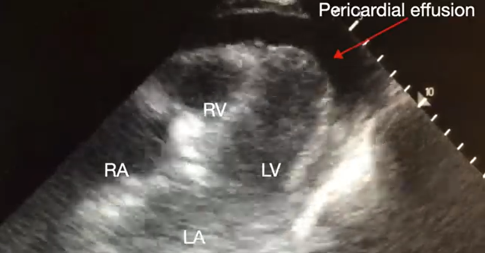 Subcostal 4-chaber view demonstrating pericardial effusion