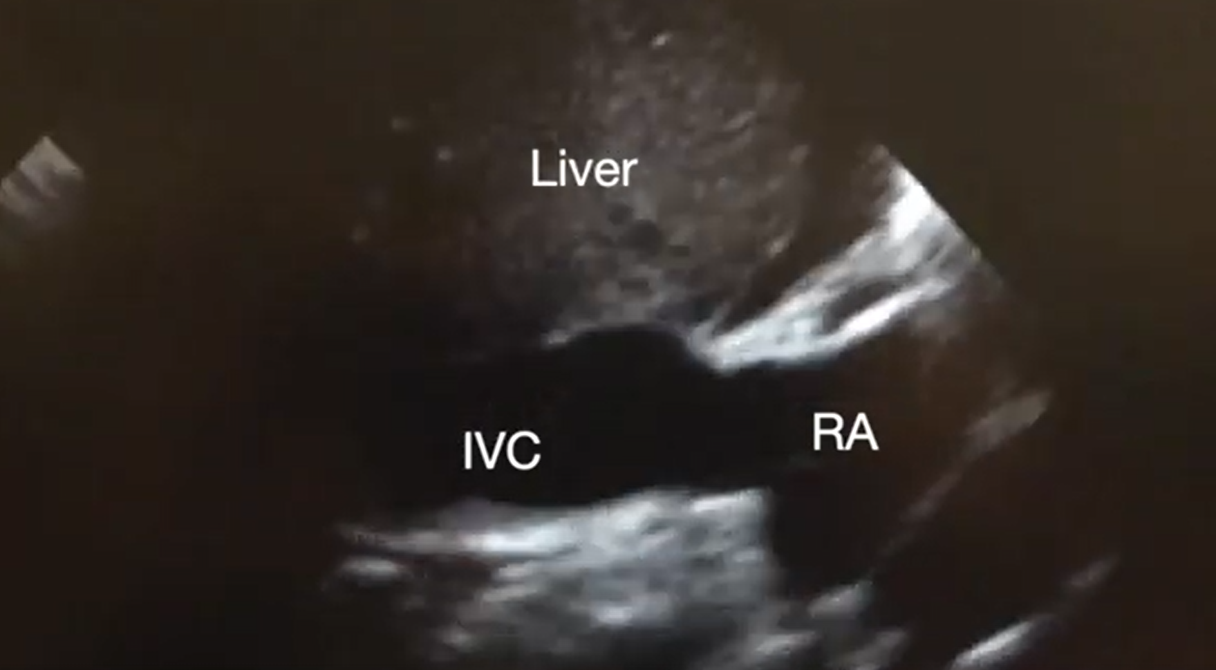 Supplemental Video 3, Subcostal IVC view demonstrating plethoric inferior vena cava (IVC) during chest compressions.