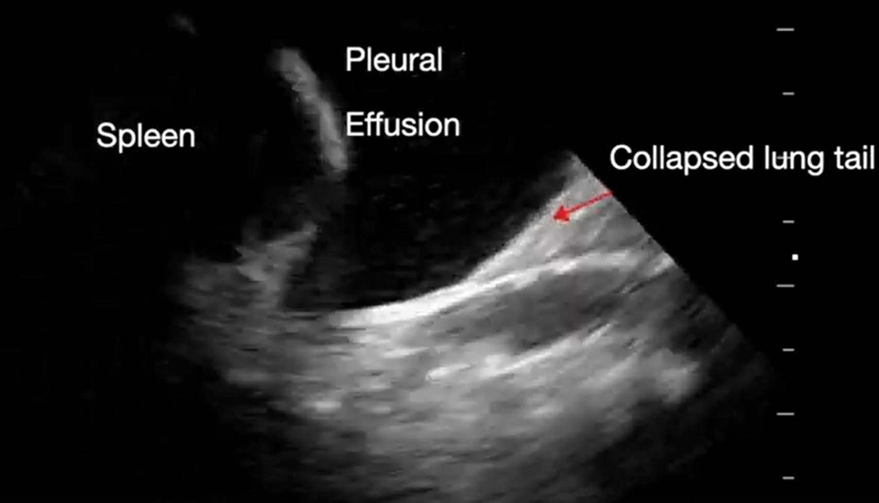 Supplemental Video 4. Sonogram of the lateral inferior thorax demonstrating pleural effusion