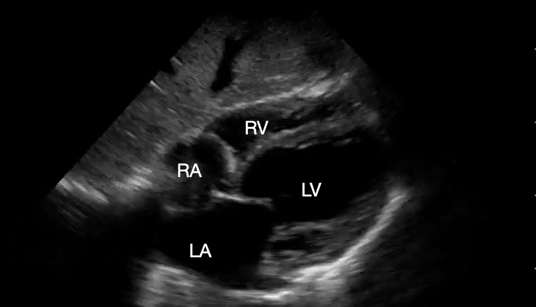 Supplemental Video 6. Subcostal 4-chaber view demonstrating dilated and depressed left ventricular function. 