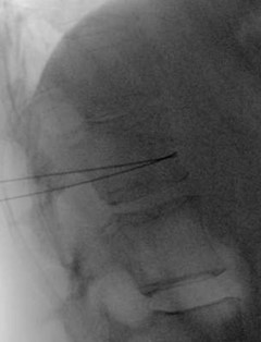 Lateral radiograph with bilateral needles fully advanced to the anterior vertebral body prior to injection of contrast. One needle is bent upward, and one needle is bent downward.