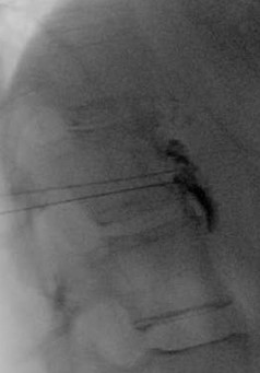 Lateral radiograph with ideal contrast spread along anterior vertebral body