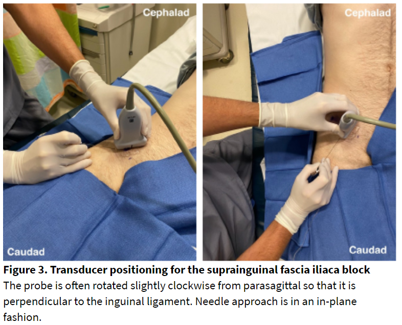 Figure 3. Transducer positioning for the suprainguinal fascia iliaca block