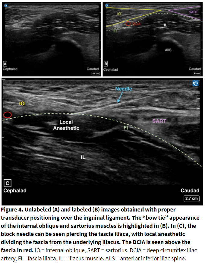 igure 4. Unlabeled (A) and labeled (B) images obtained with proper transducer positioning over the inguinal ligament. 