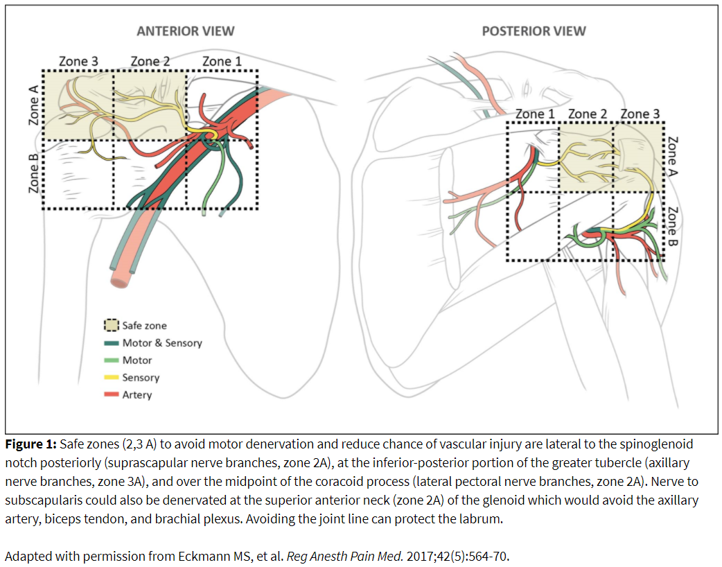 Figure 1: Safe zones to avoid motor denervation and reduce chance of vascular injury 