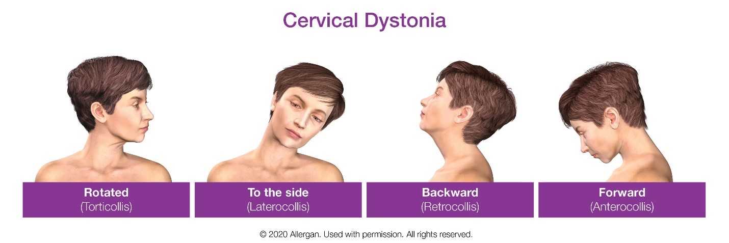 Figure 1 Shah Cervical Dystonia