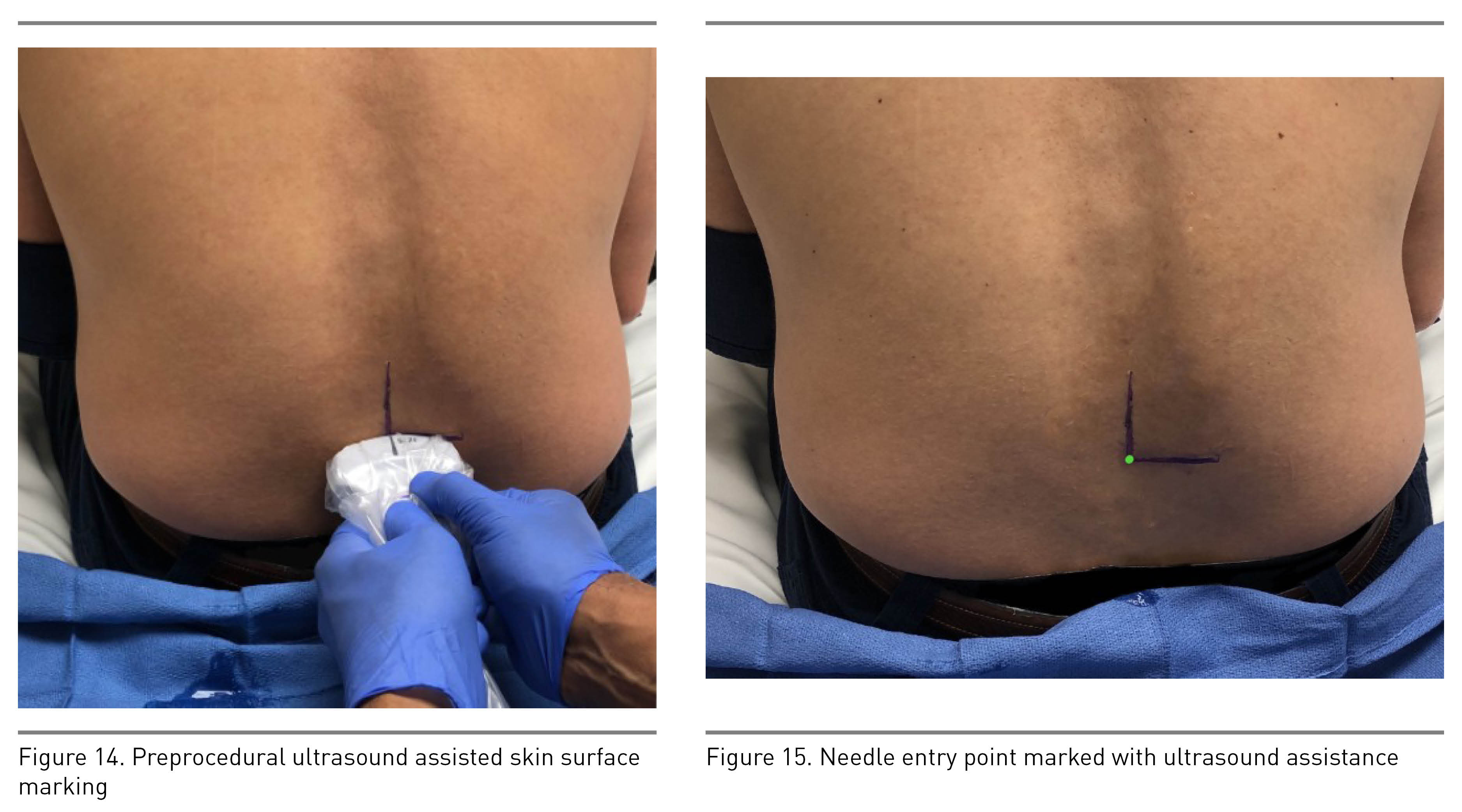 Figures 14 (preprocedural ultrasound-assisted skin surface marking) and 15 (needle entry point marked with ultrasound assistance)