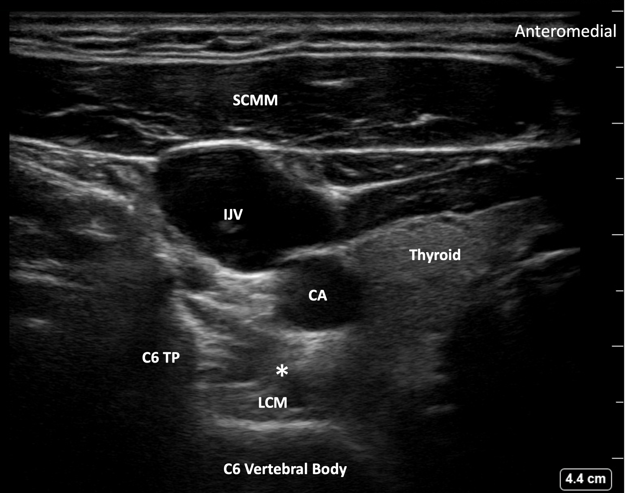 Ultrasound image showing the target for stellate ganglion block