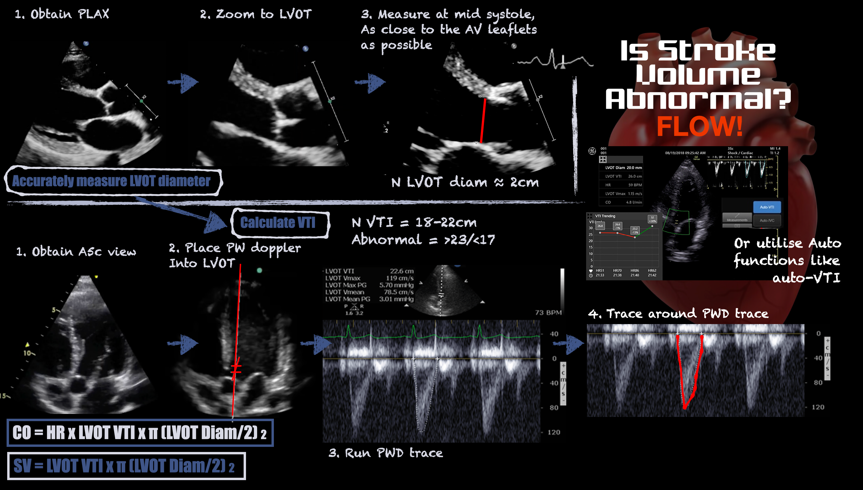 Infographic demonstrating how to measure stroke volume with ultrasound