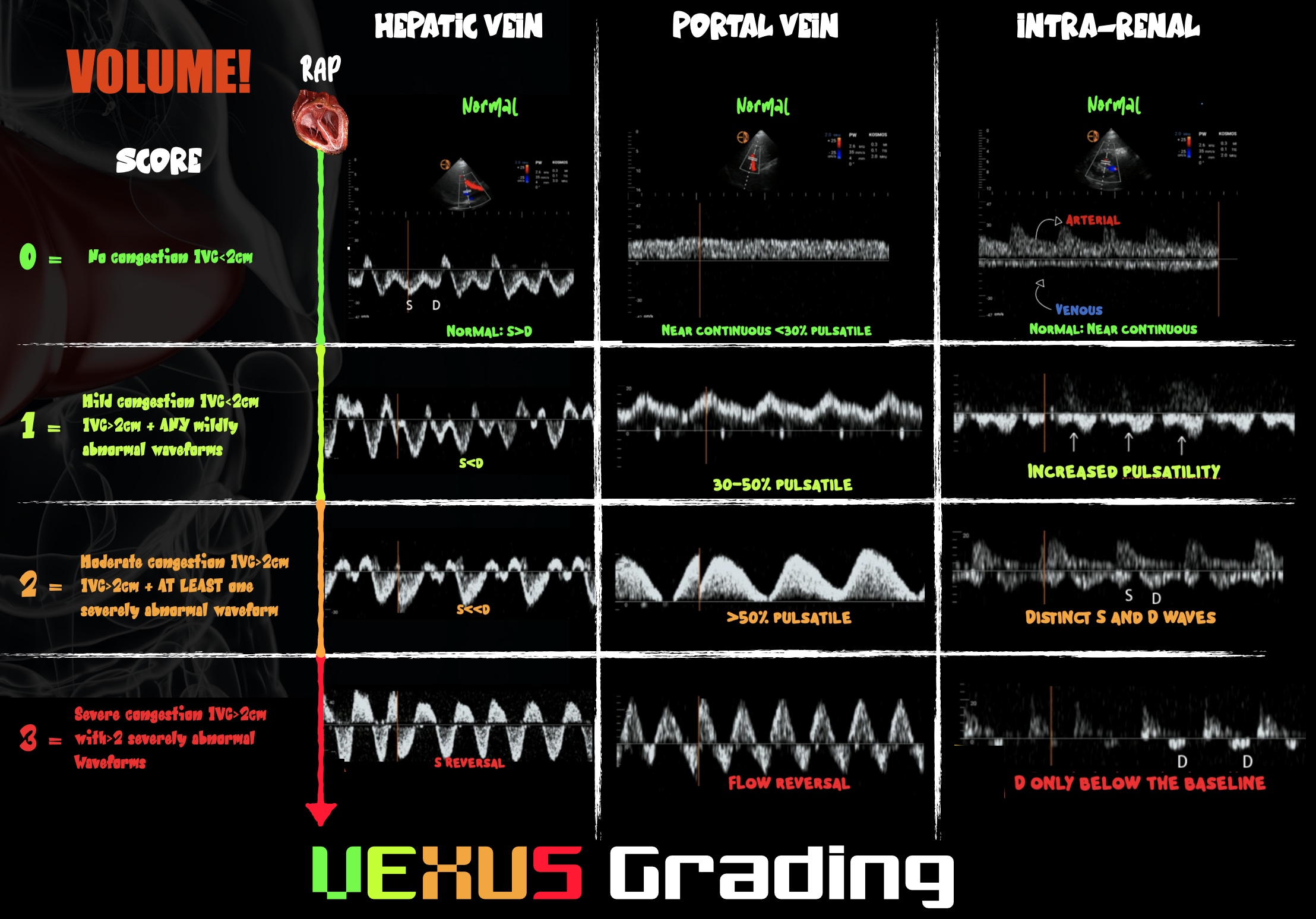 Infographic demonstrating VExUS grading
